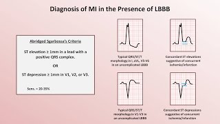 Intro to EKG Interpretation  Myocardial Infarctions Part 2 of 2 [upl. by Goda]