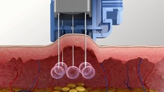 Meso Injector system for Mesotherapy Injection [upl. by Jacobina]