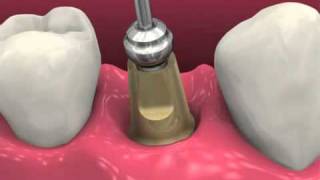 Restoring BioHorizons Dental Implants 2011 [upl. by Nyra68]