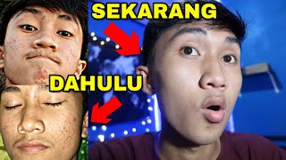 CARA MEMUDARKAN BOPENG BEKAS JERAWAT  PAKAI INI  Cek Deskripsi Video [upl. by Hunter458]