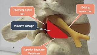 Lumbar Transforaminal Approach for Disc Herniations [upl. by Eelibuj]