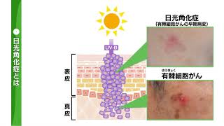 正しく理解しよう「紫外線と皮膚疾患」②日光角化症と有棘細胞がん [upl. by Arah]