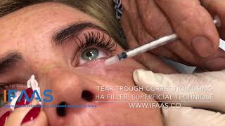 Tear Trough Correction Using Hyaluronic Acid HA Filler  Superficial Technique [upl. by Nyral]