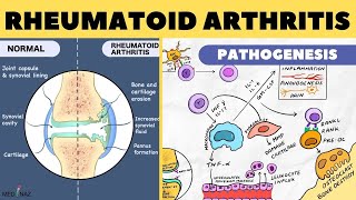 Osteoarthritis vs Rheumatoid Arthritis Nursing  Symptoms Pathophysiology Treatment Mnemonic NCLEX [upl. by Tanner]