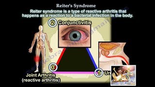 Reiters Syndrome Reactive Arthritis  Everything You Need To Know  Dr Nabil Ebraheim [upl. by Browning60]