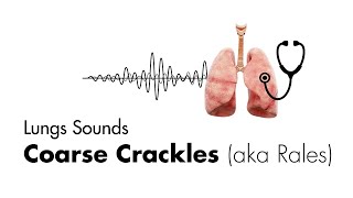 Coarse Crackles Rales  Lung Sounds  Medzcool [upl. by Nohsed]