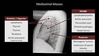 How to Interpret a Chest XRay Lesson 5  Cardiac Silhouette and Mediastinum [upl. by Ysnat]