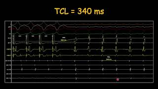 How to assess entrainment response in AVNRT [upl. by Alehc55]