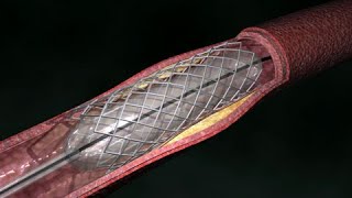 Coronary Artery Angioplasty  Radial Access [upl. by Bluefarb]