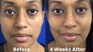 Dermal Filler Under Eyes and Cheek Restoration  Tear Trough [upl. by Onibag419]