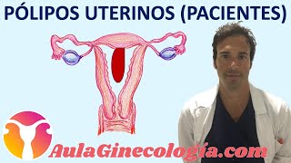 PÓLIPOS UTERINOS PACIENTES Síntomas diagnóstico y tratamiento  Ginecología y Obstetricia [upl. by Danielson]