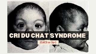 Cri Du Chat Syndrome CdCS or 5p  Genetics  Medicine [upl. by Naeroled]