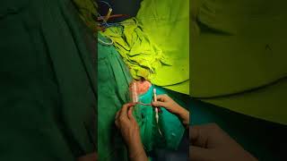 Advanced LASER Haemorrhoids Piles Treatment by Dr Hina Khan [upl. by Akinnej]