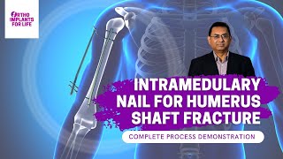 Intramedullary Nail For Humerus Shaft Fracture Procedure [upl. by Helena]