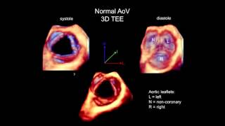 3D Echocardiography Acquisition Cropping and Case Examples [upl. by Nahtal]