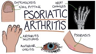 Psoriatic Arthritis [upl. by Alurd]