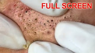 Blackheads removal  Best Pimple Popping Videos [upl. by Ardnuahsal593]