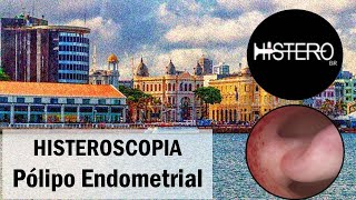 Histeroscopia Cirúrgica para Polipectomia  Pólipo Endometrial [upl. by Ahsinnod264]