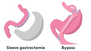 Quelles sont les techniques de chirurgie de lobésité [upl. by Anierdna161]