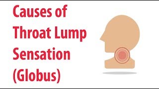 Causes of Throat Lump Sensation Globus [upl. by Soilissav430]