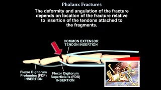 Osteoarthritis  causes symptoms diagnosis treatment amp pathology [upl. by Norihs593]