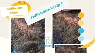 Scalp folliculitis TreatmentHairfall Treatment Dr Ashima Goel  Dermatologist Chandigarh shorts [upl. by Durarte929]