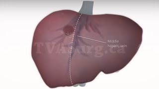 Standard right hepatectomy [upl. by Nnaeoj]