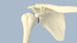 Acromioclavicular Separation Surgery [upl. by Ettenad]