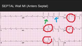 Septal MI What you may not know [upl. by Barb]