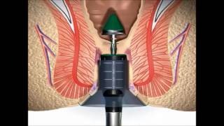 Stapled Haemorrhoidectomy using the PPH System  English [upl. by Ycnay]