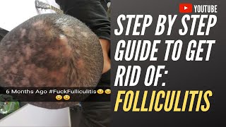 Step by step guide to get rid of folliculitis [upl. by Adigirb]