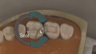 Class II Composite Restoration  Stevenson Dental Solutions [upl. by Mobley481]