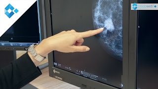 Brustdiagnostik  Knoten frühzeitig erkennen [upl. by Collier]