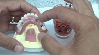 Overdenture Abutment Part 1 [upl. by Garnes533]