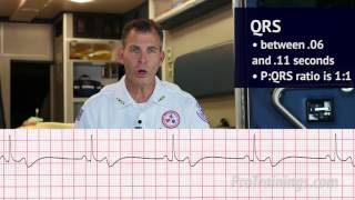 Bradycardia ECG Rhythm Interpretation [upl. by Naimed]