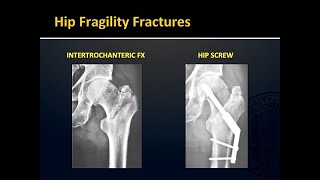 Fragility Fractures [upl. by Alister]