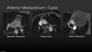 Approach to Mediastinal Masses [upl. by Ayel]