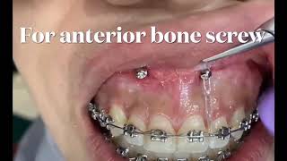 Orthodontic Mechanics used for the intrusion of the maxillary dentition [upl. by Laurens]