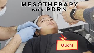 PDRN Mesotherapy AKA Biorejuvination 100 needles in my face skincare [upl. by Jezabella]