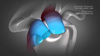 Shoulder Arthroscopy  Rotator Cuff Repair [upl. by Siladnerb]