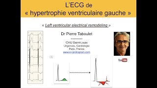 7a L’ECG de lhypertrophie ventriculaire gauche HVG Basic Dr Taboulet [upl. by Aikemit]