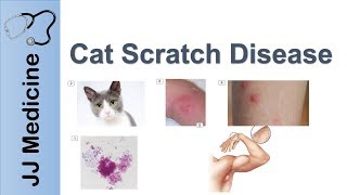 Cat Scratch Disease  Causes Symptoms and Treatment [upl. by Yracaz]