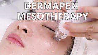 Dermapen Mesotherapy  How Microneedling Treatment Is Done  NV6130 MYCHWAY VIDEO [upl. by Upshaw329]