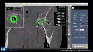 Total Hip Arthroplasty Posterior Approach with Robotic Assistance Part 1 [upl. by Tiga]