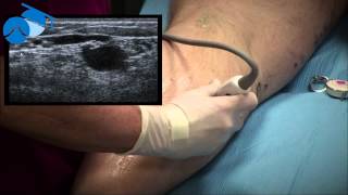 Marking of Small Saphenous Vein SSV and Incompetent Perforating Vein IPV [upl. by Papert]