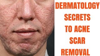 Acne scar treatments ULTIMATE GUIDE [upl. by Aenitsirhc]