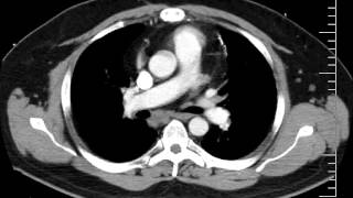 Mediastinal Anatomy on CT Discussion by a Radiologist [upl. by Dorelia]