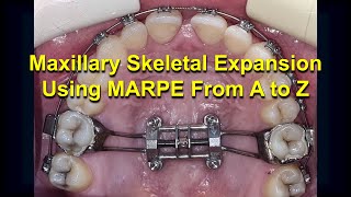 Maxillary Skeletal Expansion using MARPE from A to Z Updated [upl. by Sophie]