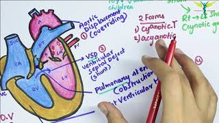 Tetralogy of Fallot TOF [upl. by Aniratac]