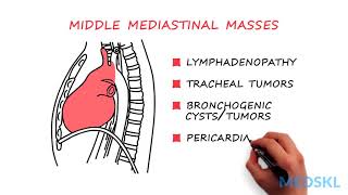 General Surgery – Mediastinal Mass By Rishindra M Reddy MD [upl. by Jessica]